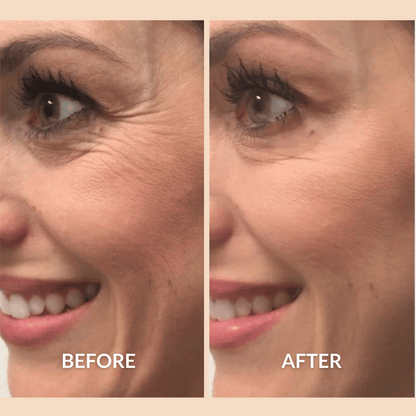 SilqueLift™ Silicone Scar Tape