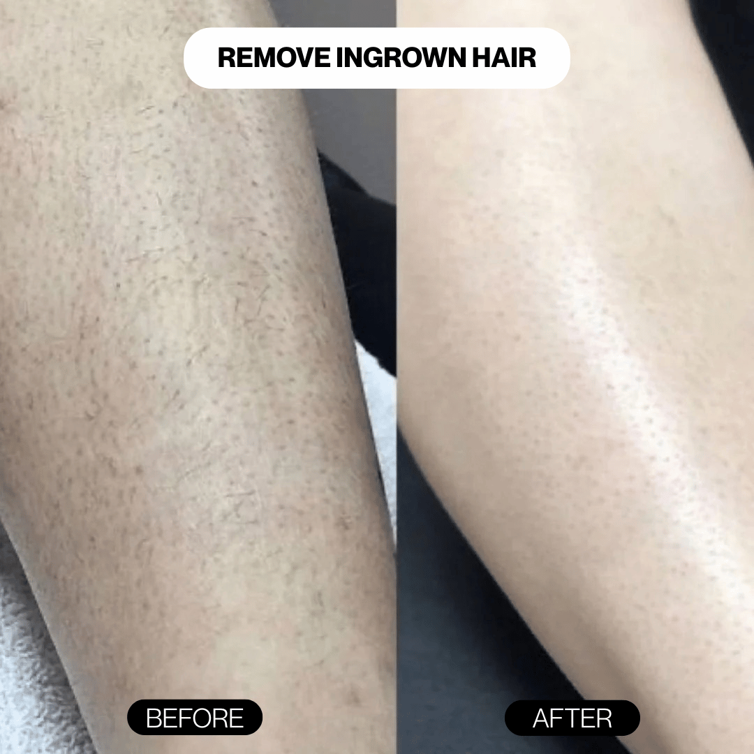 CrystalSmooth™ Hair Eraser